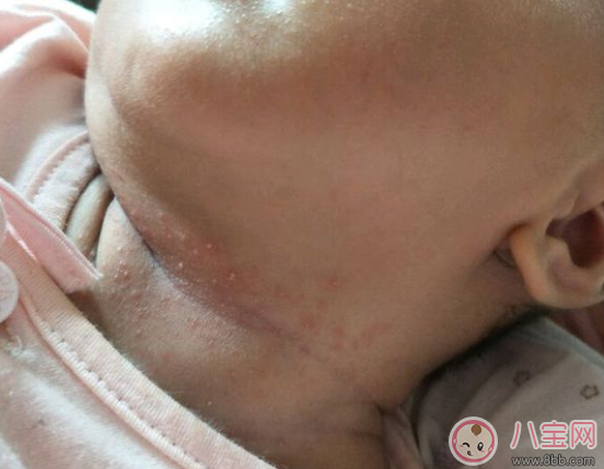 夏天寶寶脖子被淹和起痱子的區別在哪里(圖文)