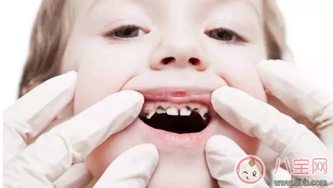 寶寶蛀牙不給醫生看 如何預防蛀牙減少寶寶痛苦