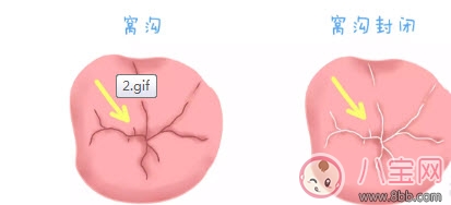 寶寶蛀牙不給醫生看 如何預防蛀牙減少寶寶痛苦