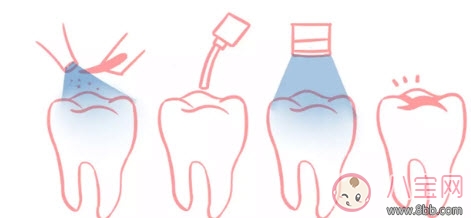 寶寶蛀牙不給醫生看 如何預防蛀牙減少寶寶痛苦