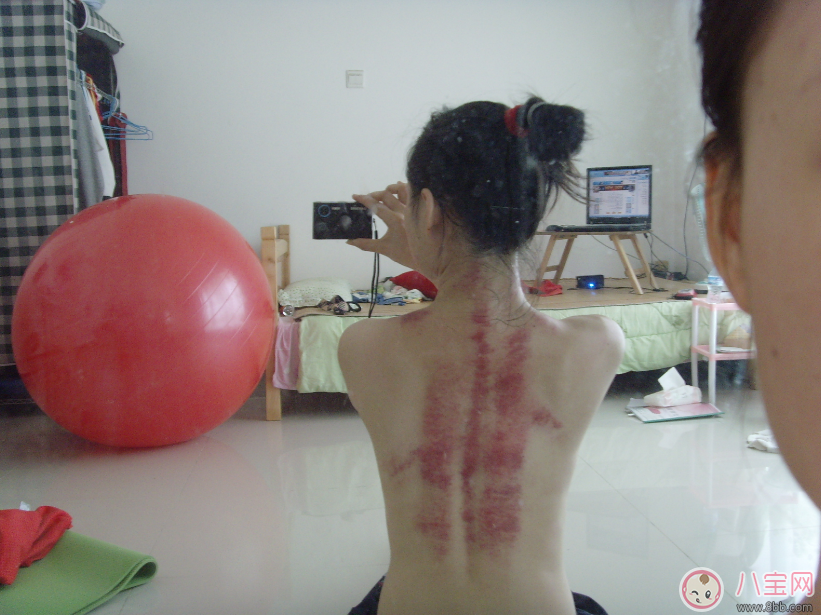 孕婦抓痧會流產嗎 中暑能抓痧嗎