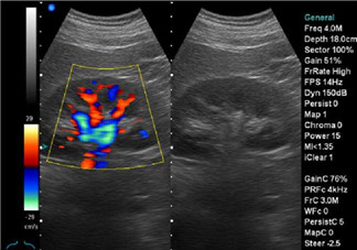 b超和彩超的區別 什么情況下使用普通B超或彩超