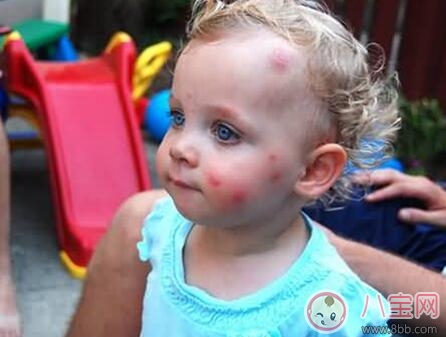 夏天寶寶招蚊子咬怎么辦 蚊子為什么總喜歡咬寶寶