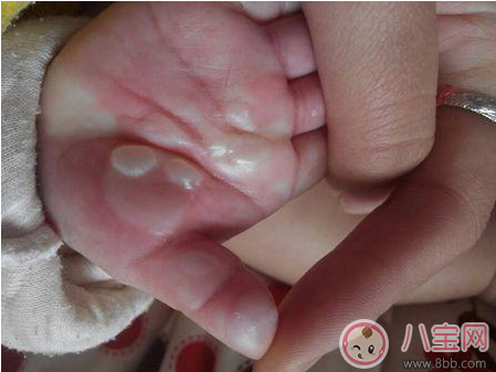 孩子燙傷后抹醬油有效嗎 這些偏方燙傷后千萬不要學