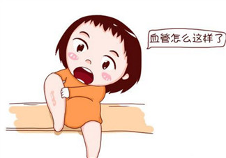 孕婦靜脈曲張是怎么回事 孕婦靜脈曲張怎么緩解