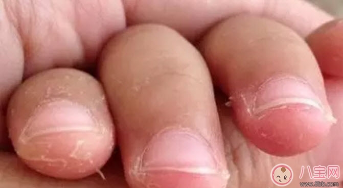 新生兒手腳脫皮要多久 新生兒脫皮怎么護(hù)理(能搽點(diǎn)什么) 新生兒手腳脫皮要多久 新生兒脫皮怎么護(hù)理(能搽點(diǎn)什么)