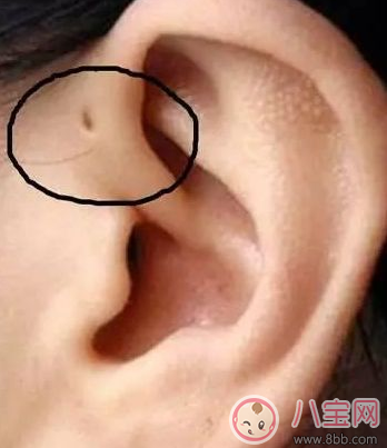 孩子耳朵上面有小孔是什么 耳朵的小孔是富貴孔嗎 孩子耳朵上面有小孔是什么 耳朵的小孔是富貴孔嗎