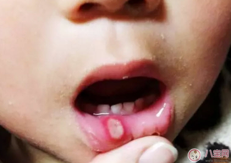 寶寶口腔潰瘍怎么辦 寶寶口腔潰瘍吃什么好的快