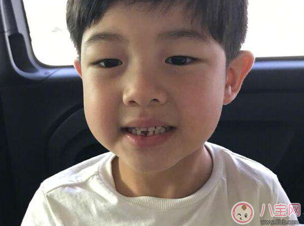 孩子換牙牙不掉 孩子雙排牙要不要拔 孩子換牙牙不掉 孩子雙排牙要不要拔