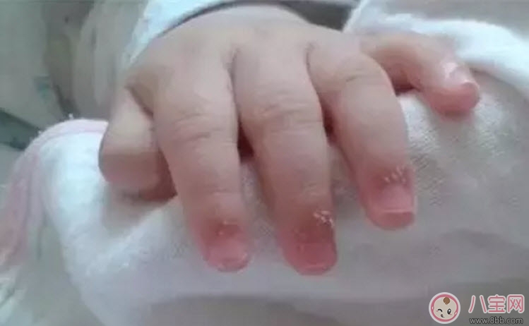 寶寶手上長肉刺是因為缺乏營養嗎 寶寶手指上長倒刺是什么原因 寶寶手上長肉刺是因為缺乏營養嗎 寶寶手指上長倒刺是什么原因