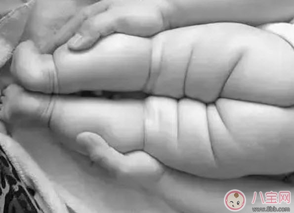 寶寶臀紋不對稱怎么回事 臀紋不對稱一定是髖關(guān)節(jié)發(fā)育不良嗎 寶寶臀紋不對稱怎么回事 臀紋不對稱一定是髖關(guān)節(jié)發(fā)育不良嗎