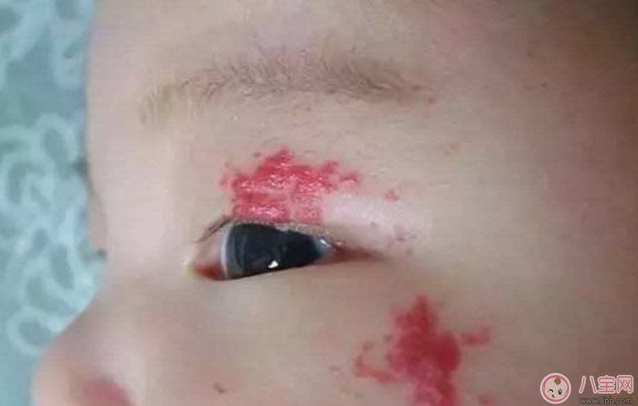 寶寶胎記多大治療最好 寶寶治療胎記的最佳時間