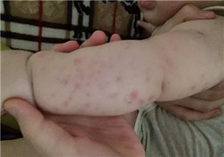 寶寶螨蟲過敏怎么辦，寶寶被螨蟲咬和蚊子咬癥狀對比圖片區別