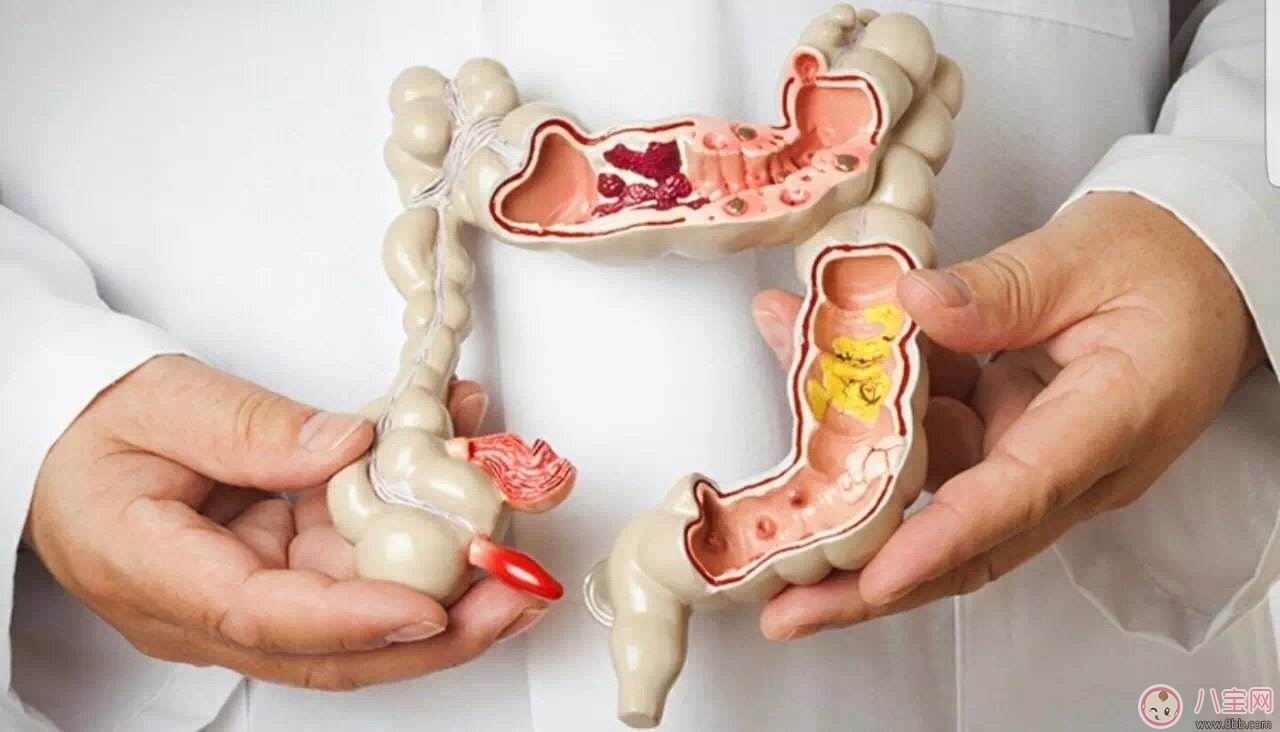 大腸癌常見癥狀 如何預防大腸癌 大腸癌常見癥狀 如何預防大腸癌