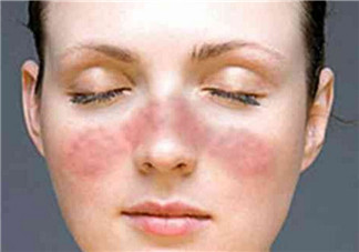 孕婦有紅斑狼瘡能不能生下健康的寶寶 紅斑狼瘡有哪些危害