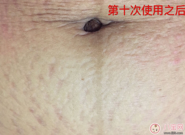 哈羅閃孕婦防妊娠紋按摩油有用嗎 哈羅閃和維蕾德哪個好(孕婦分享) 哈羅閃孕婦防妊娠紋按摩油有用嗎 哈羅閃和維蕾德哪個好(孕婦分享)