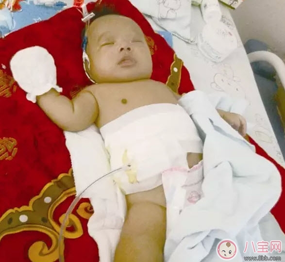 先天性膽道閉鎖治療可以治療嗎 先天性膽道閉鎖要花多少錢