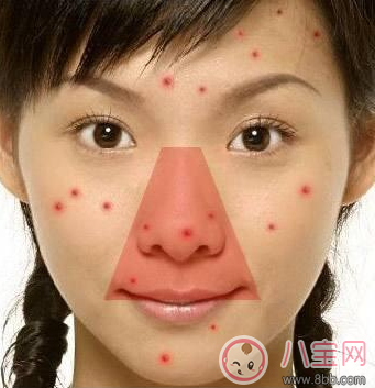 擠痘痘容易發生生命危險 怎么擠痘痘好