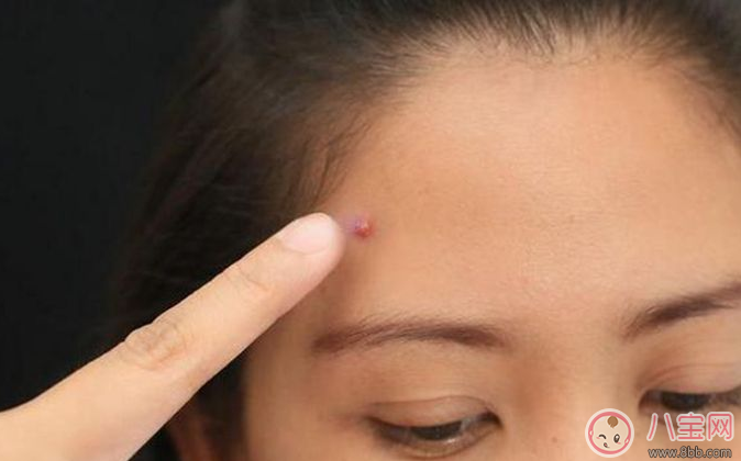 擠痘痘容易發生生命危險 怎么擠痘痘好