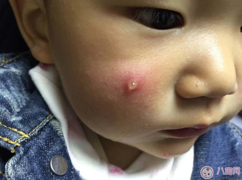 擠痘痘容易發生生命危險 怎么擠痘痘好