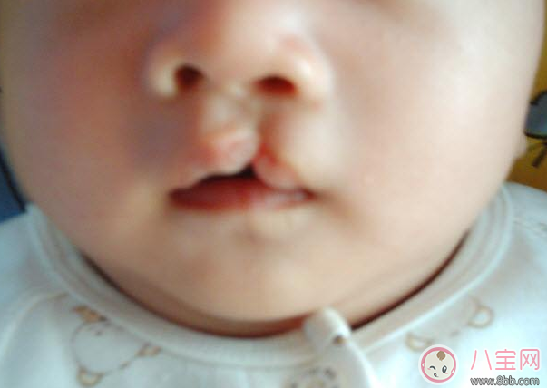 胎兒彩超檢查檢查出唇裂 幾個月能檢查出腭裂【附治療流程】