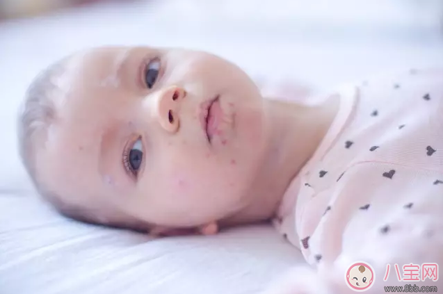 丸榮螨蟲貼有用嗎 丸榮螨蟲貼寶寶用效果好不好