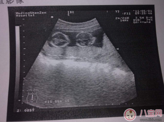 孕檢B超要問(wèn)醫(yī)生哪些問(wèn)題 孕檢B超后必問(wèn)的醫(yī)生的問(wèn)題