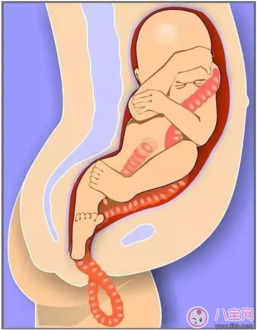 臍帶脫垂的緊急處理辦法是什么 如何預防臍帶脫垂