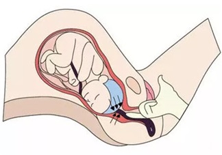 臍帶脫垂的緊急處理辦法是什么 如何預防臍帶脫垂