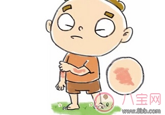 寶寶和孕婦得了蕁麻疹能用爐甘石洗劑嗎 爐甘石洗劑真的有效嗎