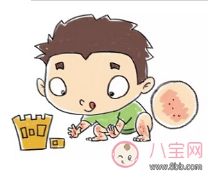 寶寶和孕婦得了蕁麻疹能用爐甘石洗劑嗎 爐甘石洗劑真的有效嗎