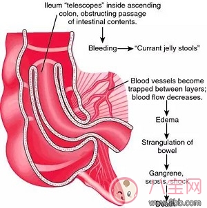 腸道疊的三大典型癥狀是什么 腸道疊是怎么引起的怎么治療預(yù)防