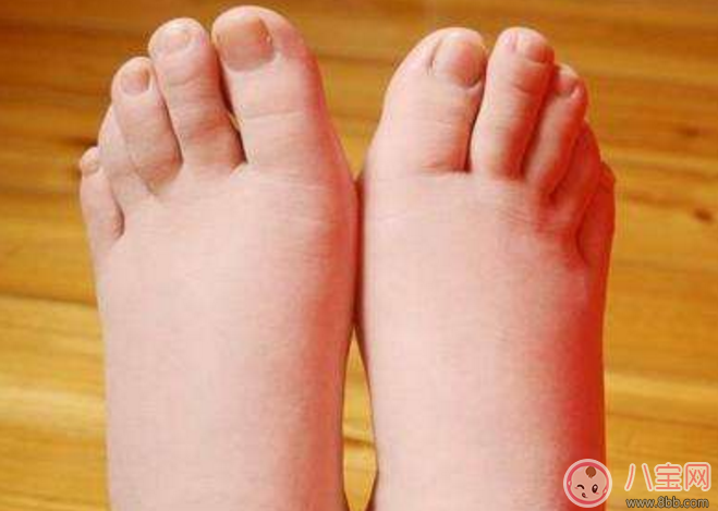 孕婦病理性水腫什么癥狀 孕期病理性水腫會高血壓嗎