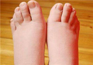 孕婦病理性水腫什么癥狀 孕期病理性水腫會(huì)高血壓嗎