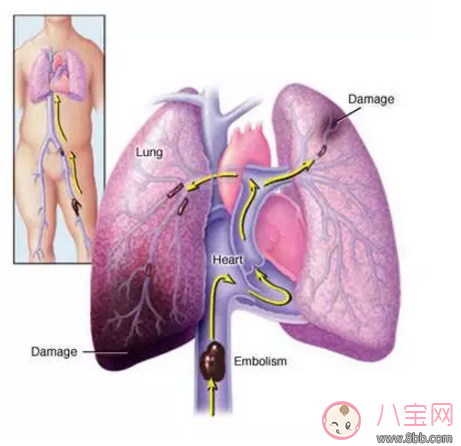 產后媽媽20天只吃不動好不好 新媽媽坐月子不活動有什么危害