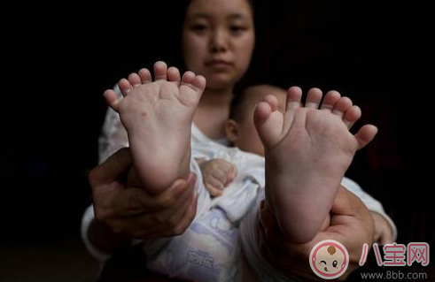 多指癥會遺傳幾代 多指癥由顯性基因控制還是隱性基因控制