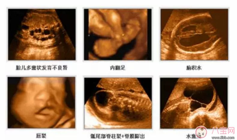 四維彩超多少錢 四維彩超檢查報告怎么看