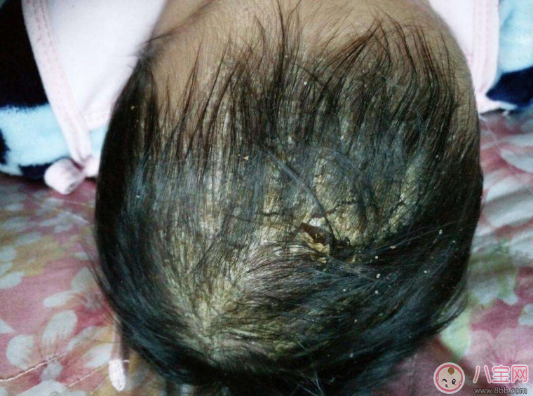 孩子的舅舅屎摳了會怎么樣 摳舅舅屎會有什么影響 孩子的舅舅屎摳了會怎么樣 摳舅舅屎會有什么影響