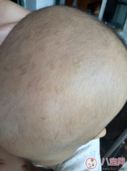 孩子的舅舅屎摳了會怎么樣 摳舅舅屎會有什么影響 孩子的舅舅屎摳了會怎么樣 摳舅舅屎會有什么影響