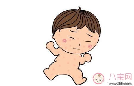 寶寶濕疹是如何引起的 寶寶濕疹的最佳治療方法
