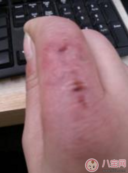 怎么預(yù)防寶寶冬天被凍傷 寶寶凍傷了怎么處理 怎么預(yù)防寶寶冬天被凍傷 寶寶凍傷了怎么處理