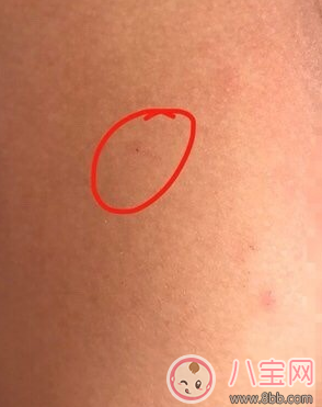 紅黃藍幼兒園孩子針孔注射的什么 為什么幼兒園要跟孩子打針