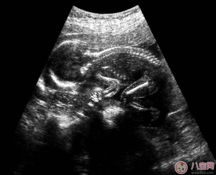 懷孕做了X光之后會(huì)怎么樣 做X光后多久可以懷孕