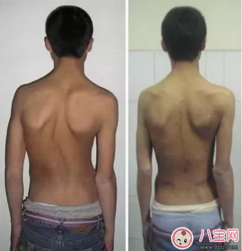 孩子總低頭玩王者榮耀會(huì)脊椎側(cè)彎嗎   如何檢查寶寶是否脊椎側(cè)彎