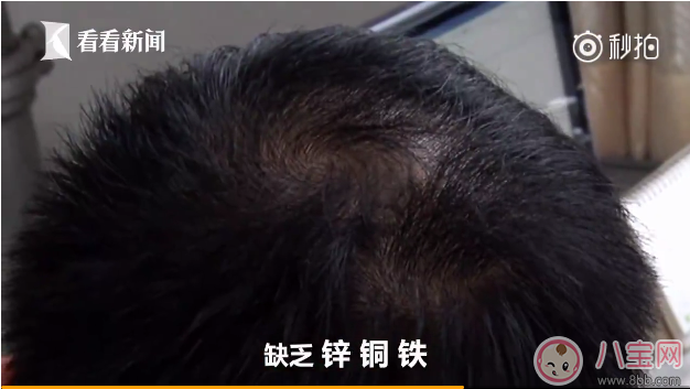 孩子得斑禿怎么辦 去醫院看斑禿掛什么科