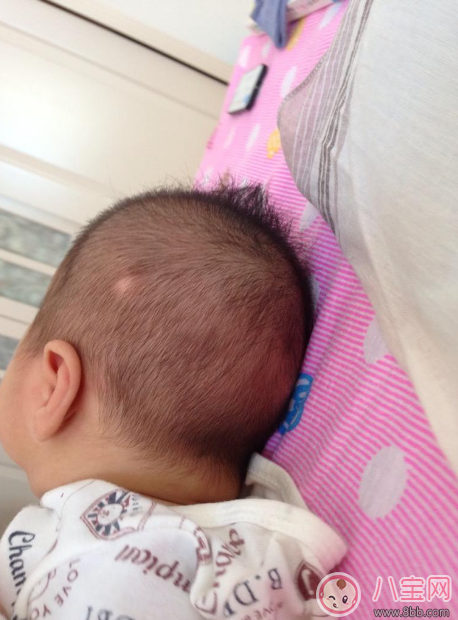 孩子得斑禿怎么辦 去醫院看斑禿掛什么科