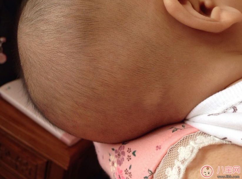 孩子得斑禿怎么辦 去醫院看斑禿掛什么科