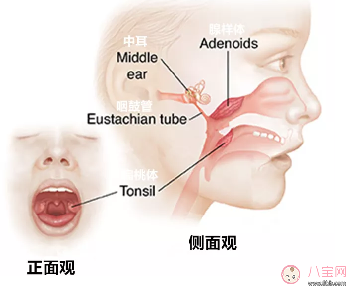 孩子喜歡打鼾是不是因為扁桃體發炎 孩子扁桃體發炎怎么辦