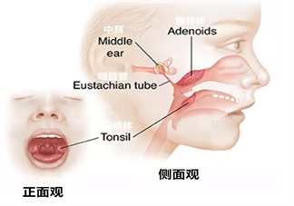 孩子喜歡打鼾是不是因為扁桃體發(fā)炎 孩子扁桃體發(fā)炎怎么辦
