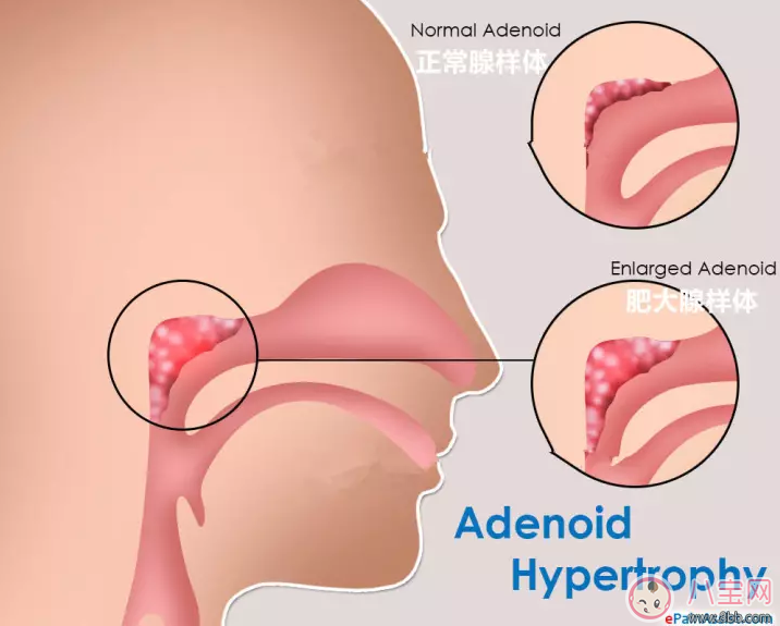 孩子喜歡打鼾是不是因為扁桃體發炎 孩子扁桃體發炎怎么辦